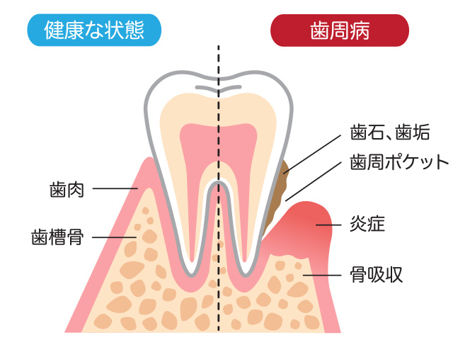 歯周病の原因